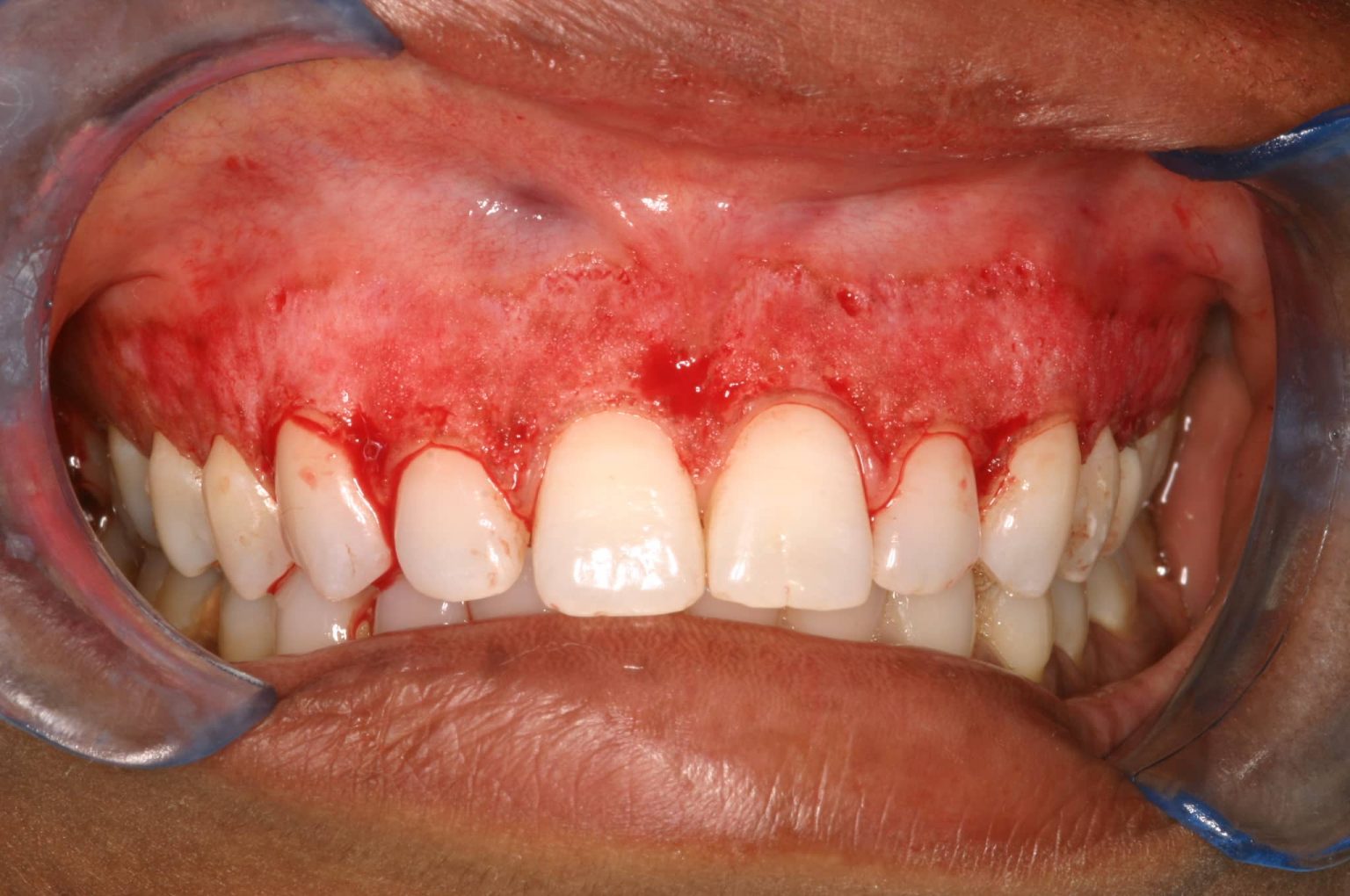 Gum Depigmentation - Dr. TALAL AL ALAWI DENTAL CENTER