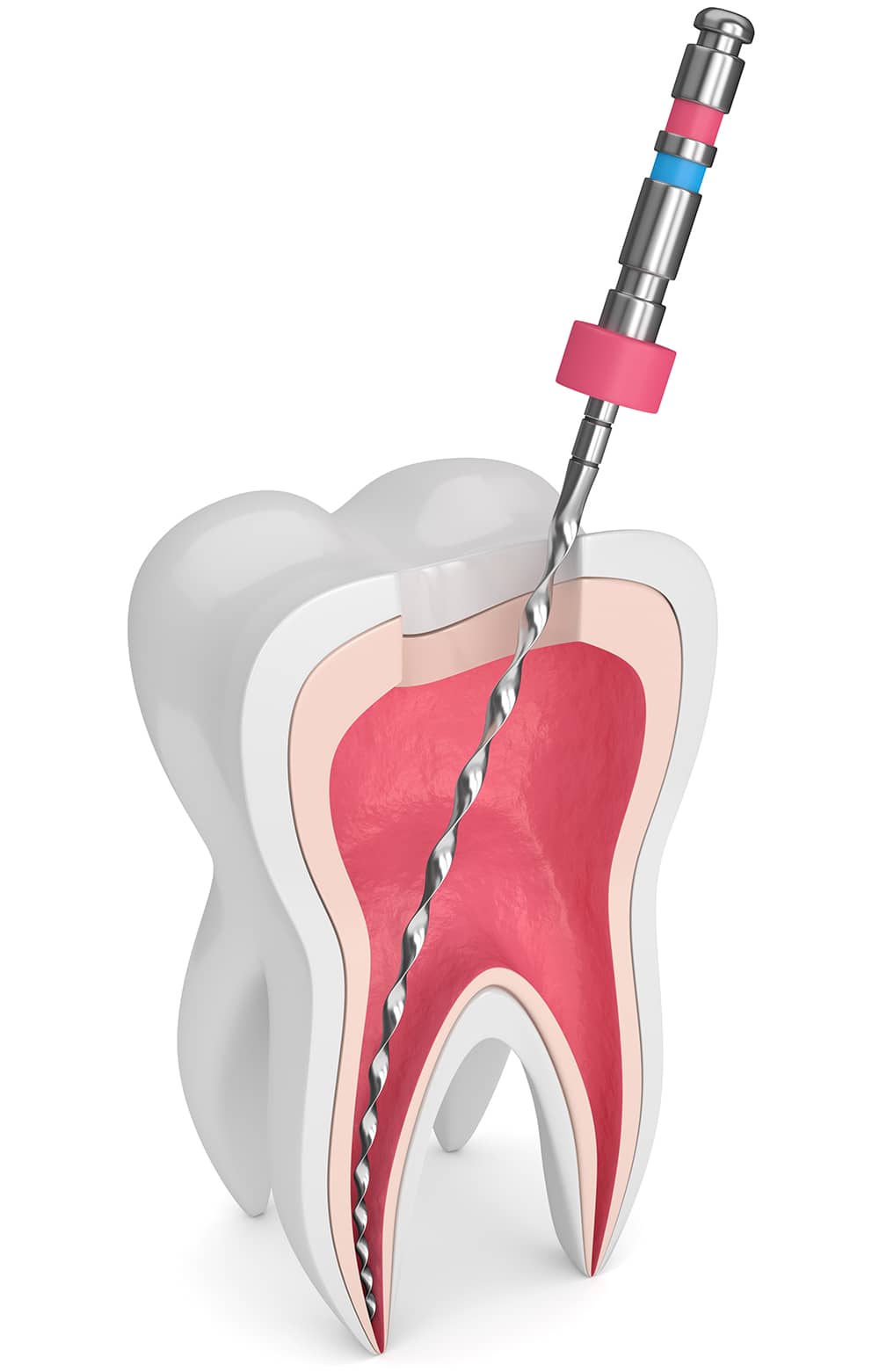 Root Canal Treatment 2 (1)